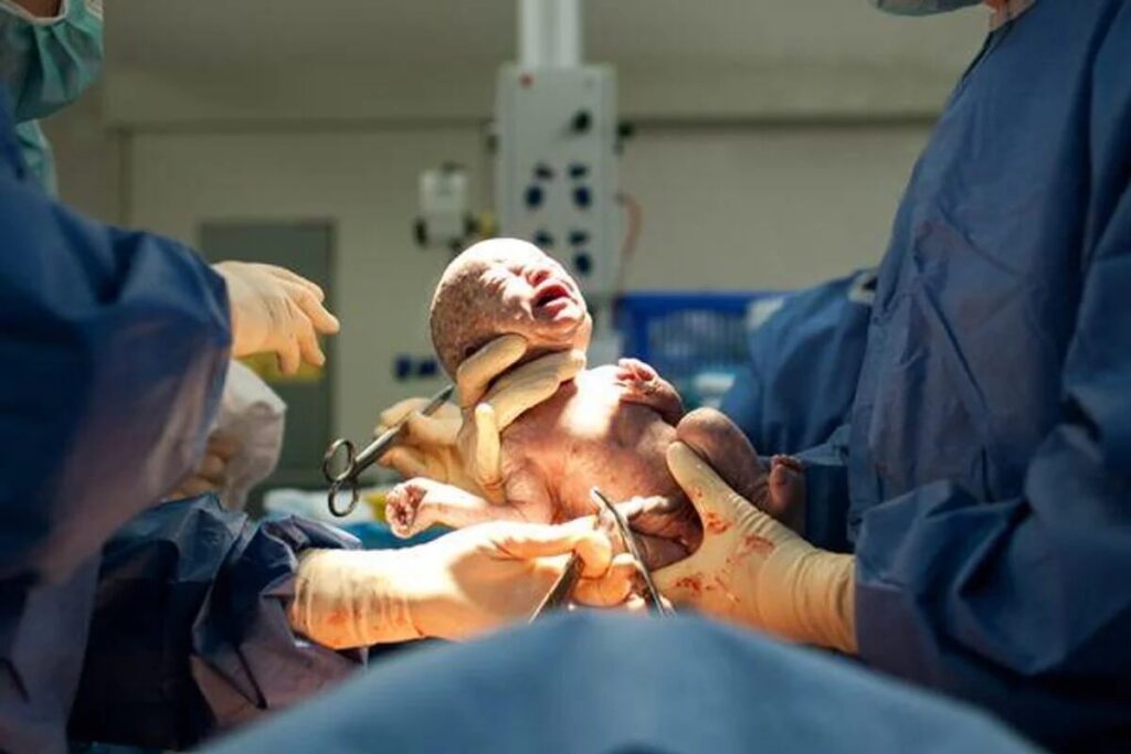 Caesarean Delivery